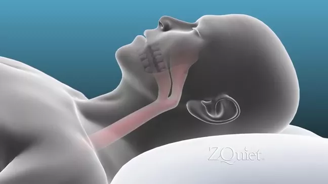 ZQuiet Anti-Snoring Mouthpiece 2-Size Starter Pack - Image 3
